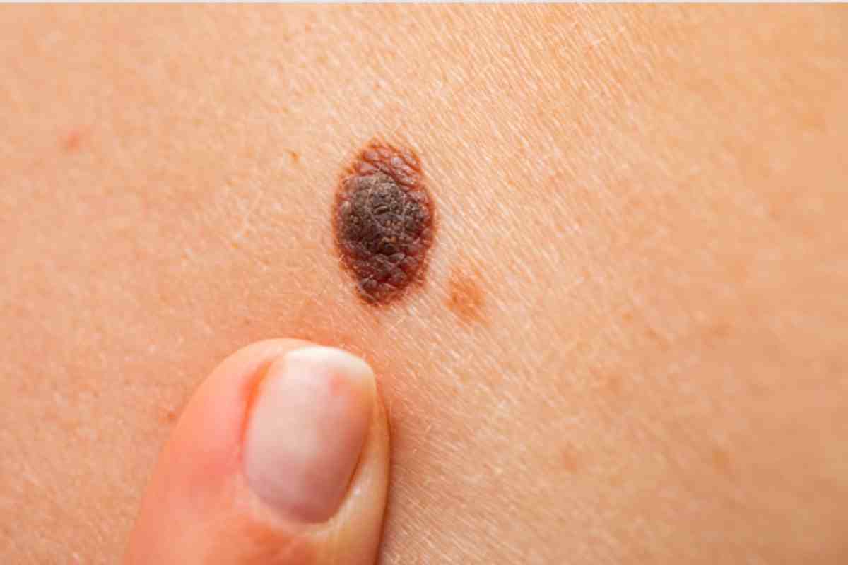 melanoma quali sono i sintomi