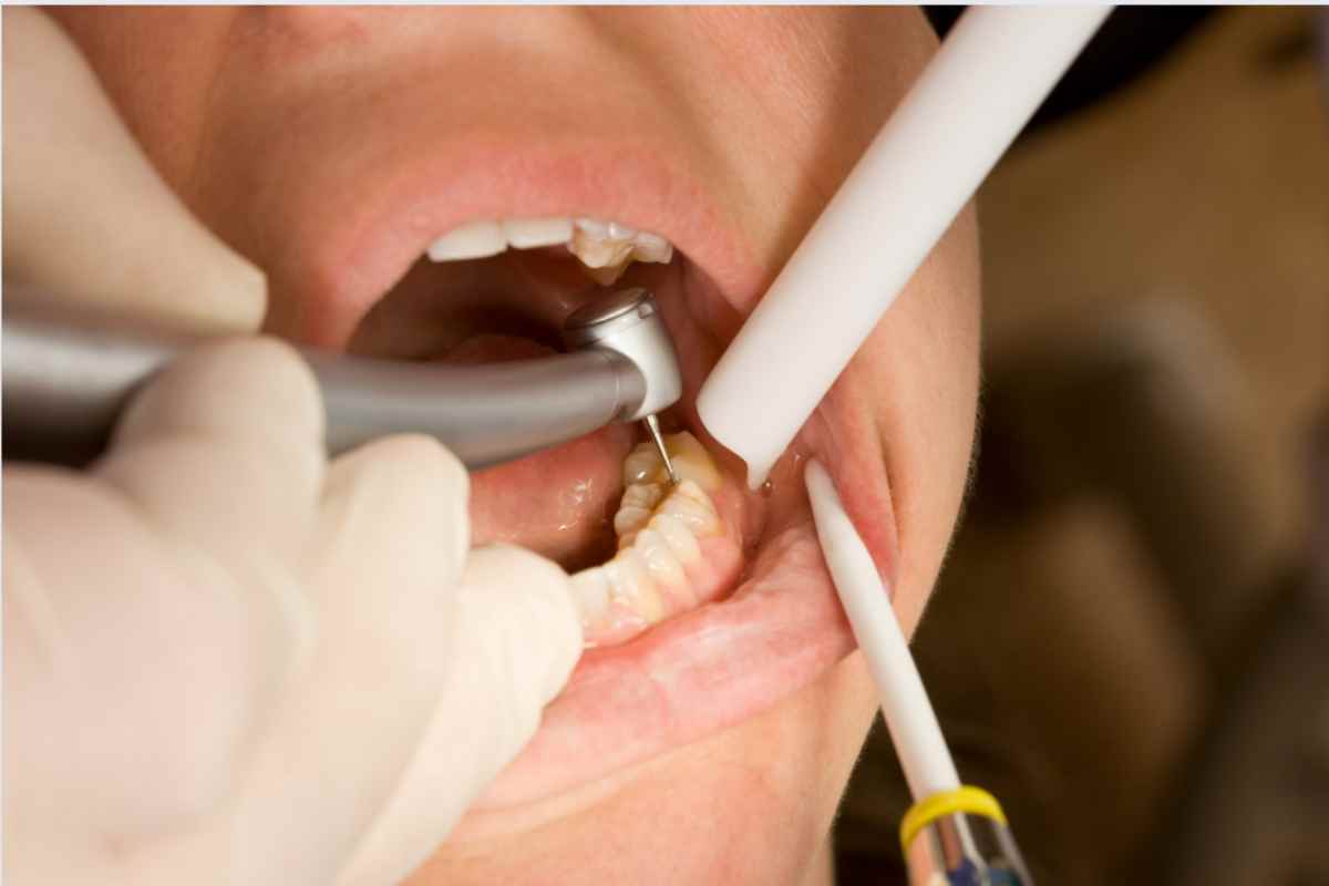 correre dal dentista per otturazione